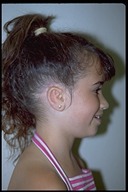 Microtia-After2