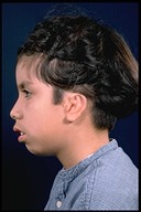 Microtia-After4