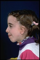 Microtia-After5