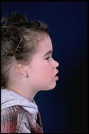 Microtia-Before2