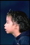 Microtia-Before4