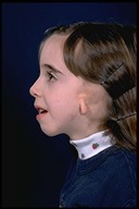 Microtia-Before5