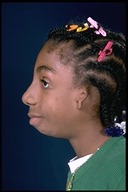 Microtia-Before6