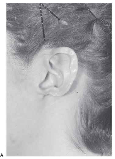 Earlobe reconstruction 1