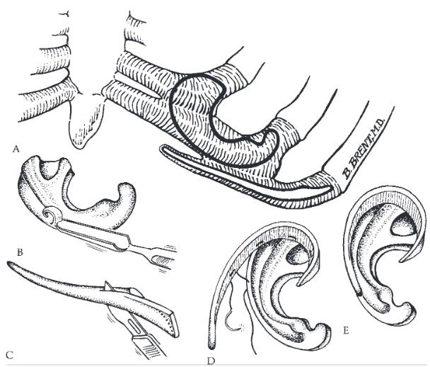Fabrication of ear framework