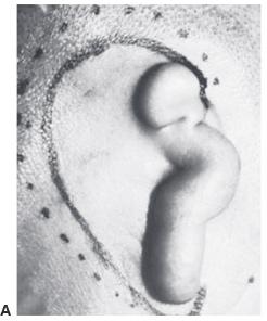 Insertion of the ear framework 1