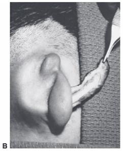 Insertion of the ear framework 2