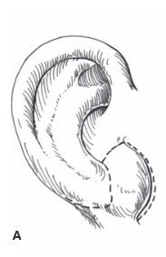 Rotation of lobule 2