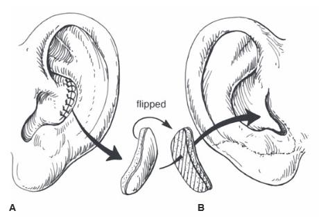 Construction of tragus 1