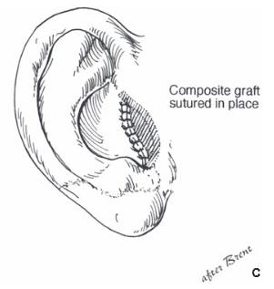 Construction of tragus 2