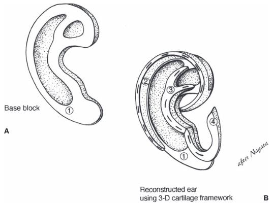Fabrication of ear framework from rib cartilage
