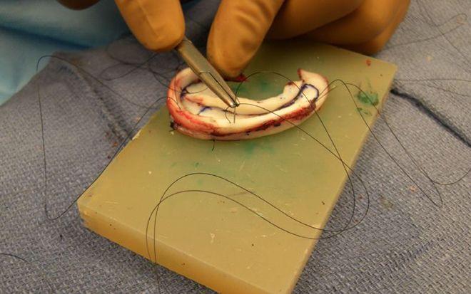 Treatment of ear deformities