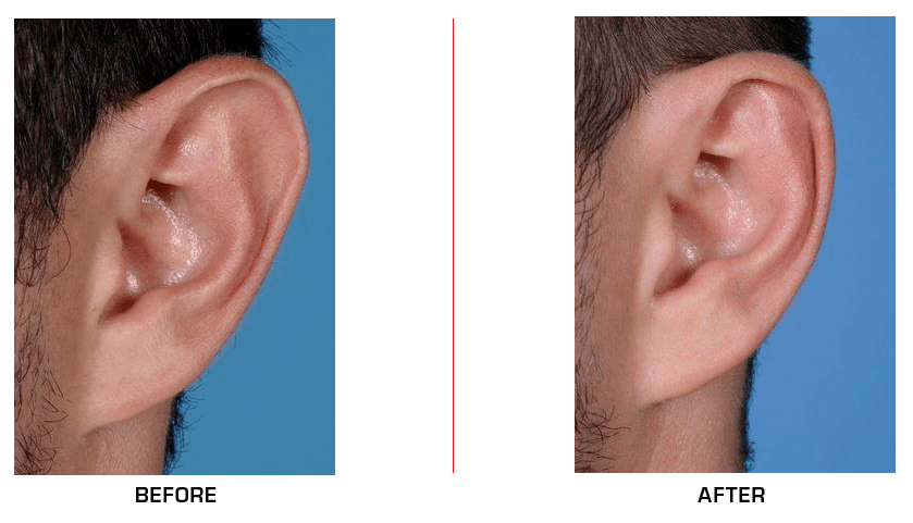 Ear Reduction before after case1