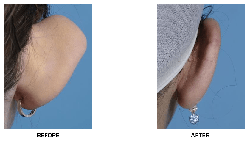 Ear Reduction before after case2