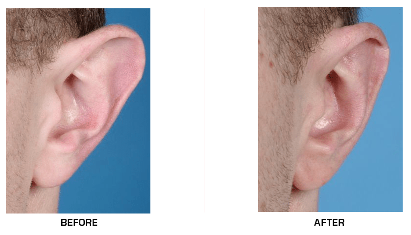 Ear Reduction before after case3