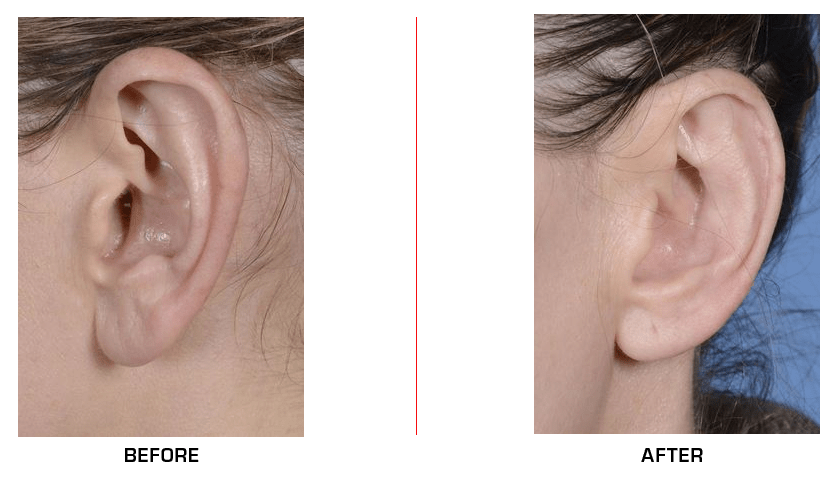 Ear Reduction before after case4