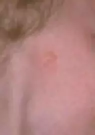 anotia (complete absence of ear)