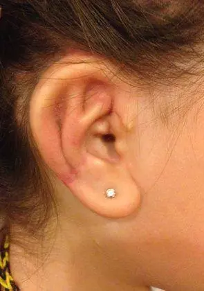 Patient's ear after aural atresia repair
