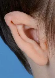 large conchal microtia