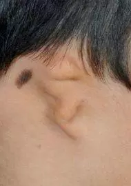 lobular microtia with very small lobule