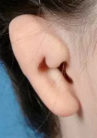 small conchal microtia