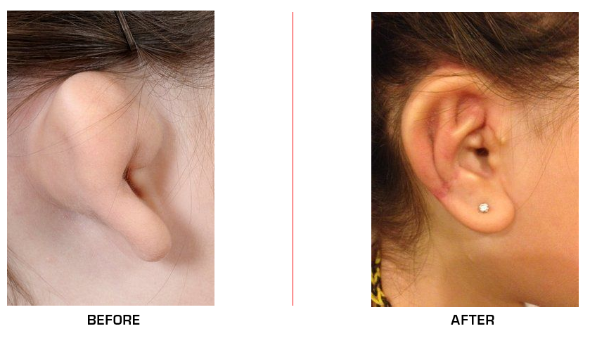 Microtia before after case1