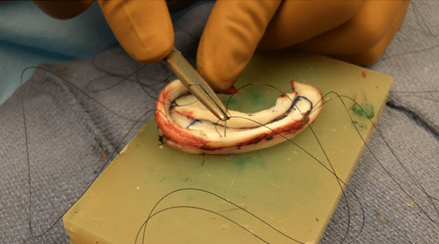 cartilage are sutured together