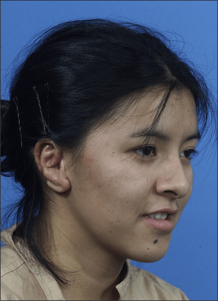 redo ear reconstruction after