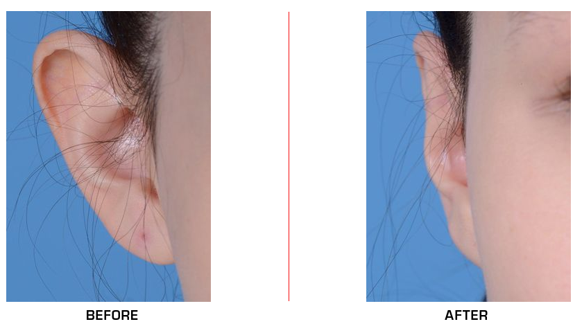 otoplasty before after case1