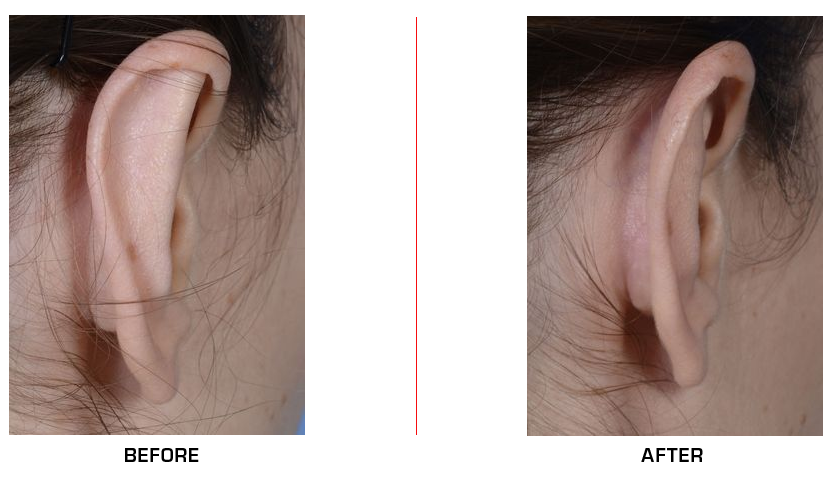 otoplasty before after case2