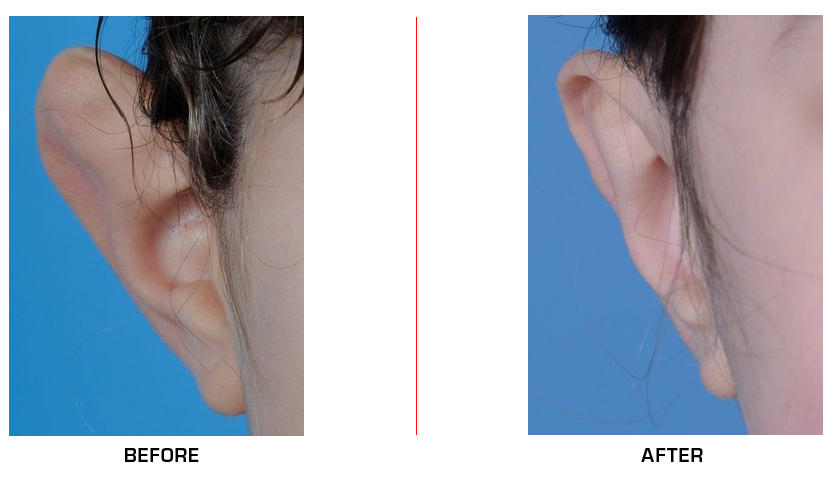 otoplasty before after case3