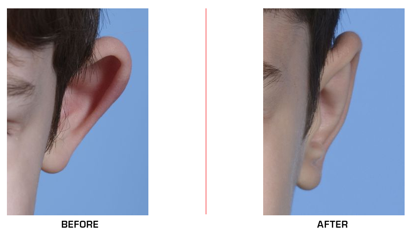 otoplasty before after case4