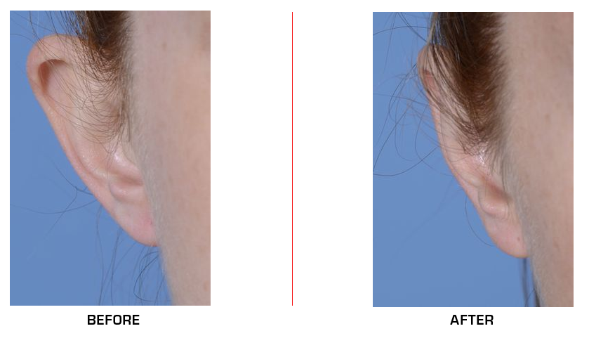 otoplasty before after case5