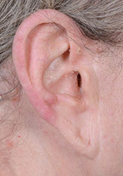 ear distortion before