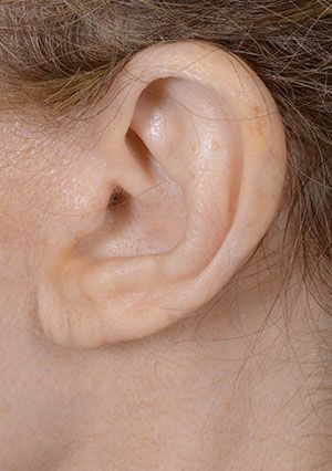 earlobe shortening after